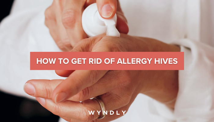 How To Get Rid Of Allergy Hives